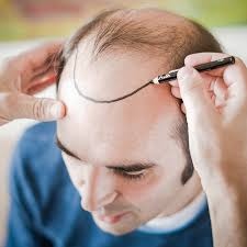 Affordable Haartransplantation Türkei Kosten Solutions for Hair Restoration